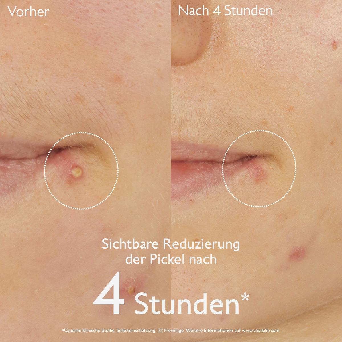 Caudalie Vinopure Salicylic Spot Solution