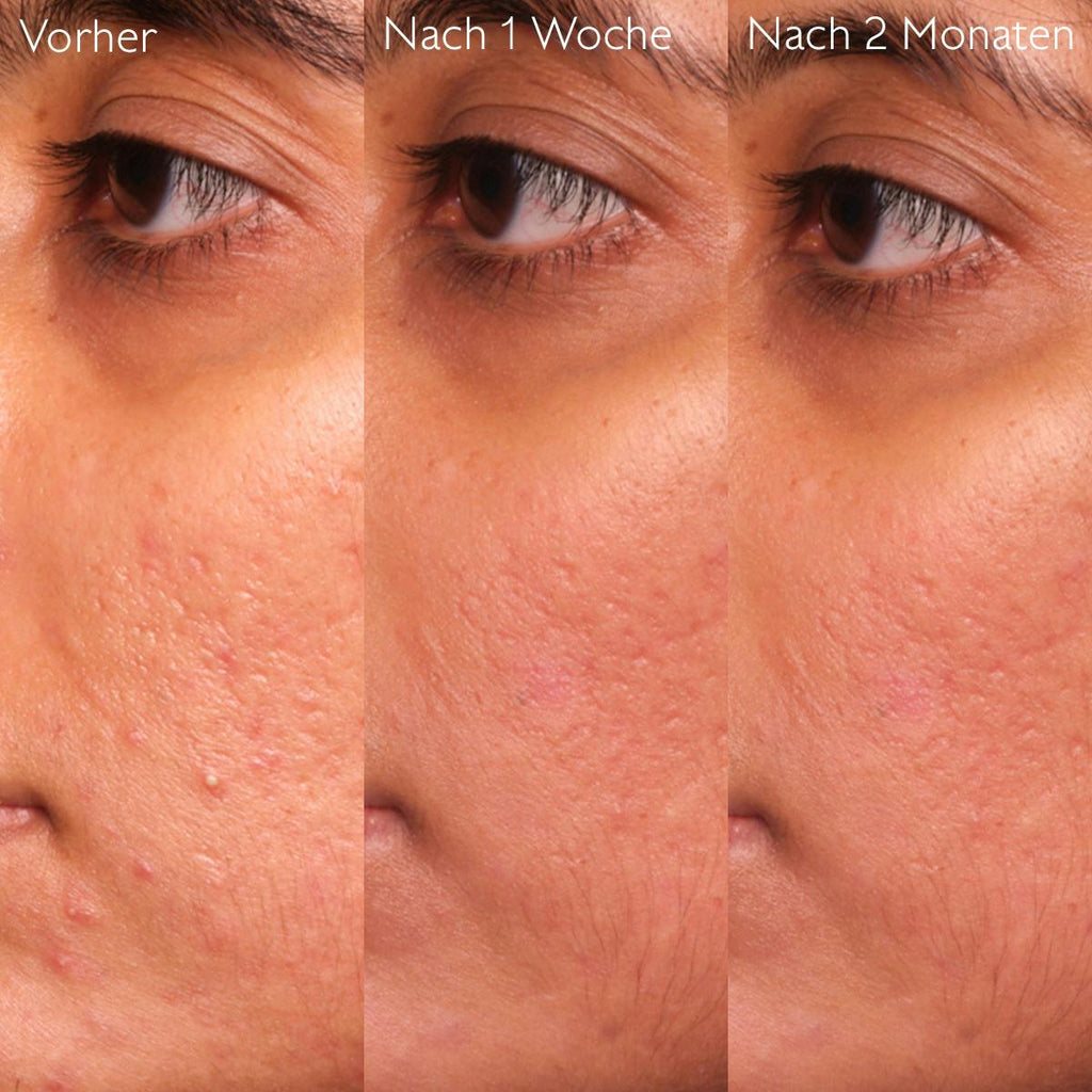 Caudalie Vinopure Salicylic Serum 30mL