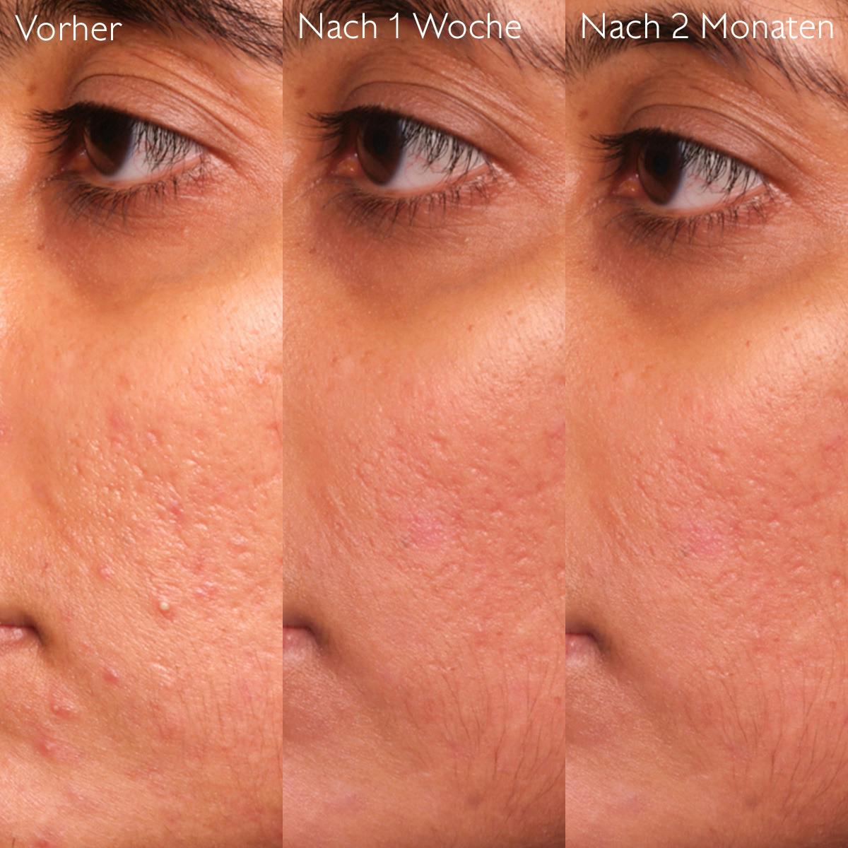 Caudalie Vinopure Salicylic Serum 30mL