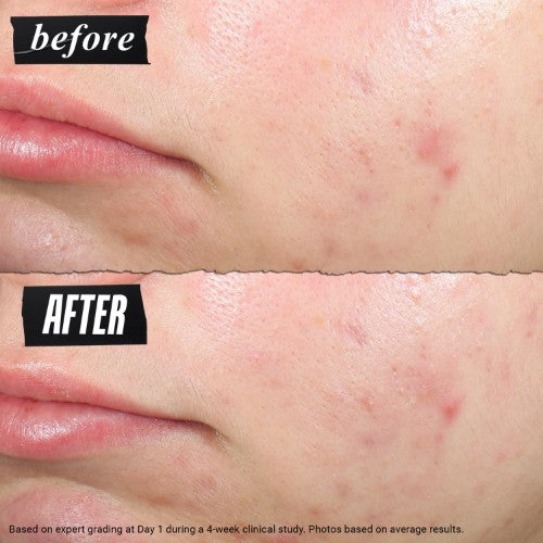 Kiehl’s Truly Targeted Blemish-Clearing Solution